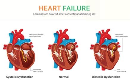 right sided heart failure ICD 10